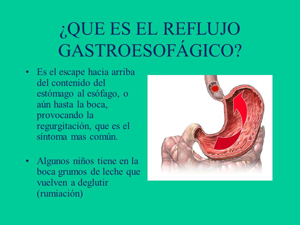 Reflujo en ninos sintomas